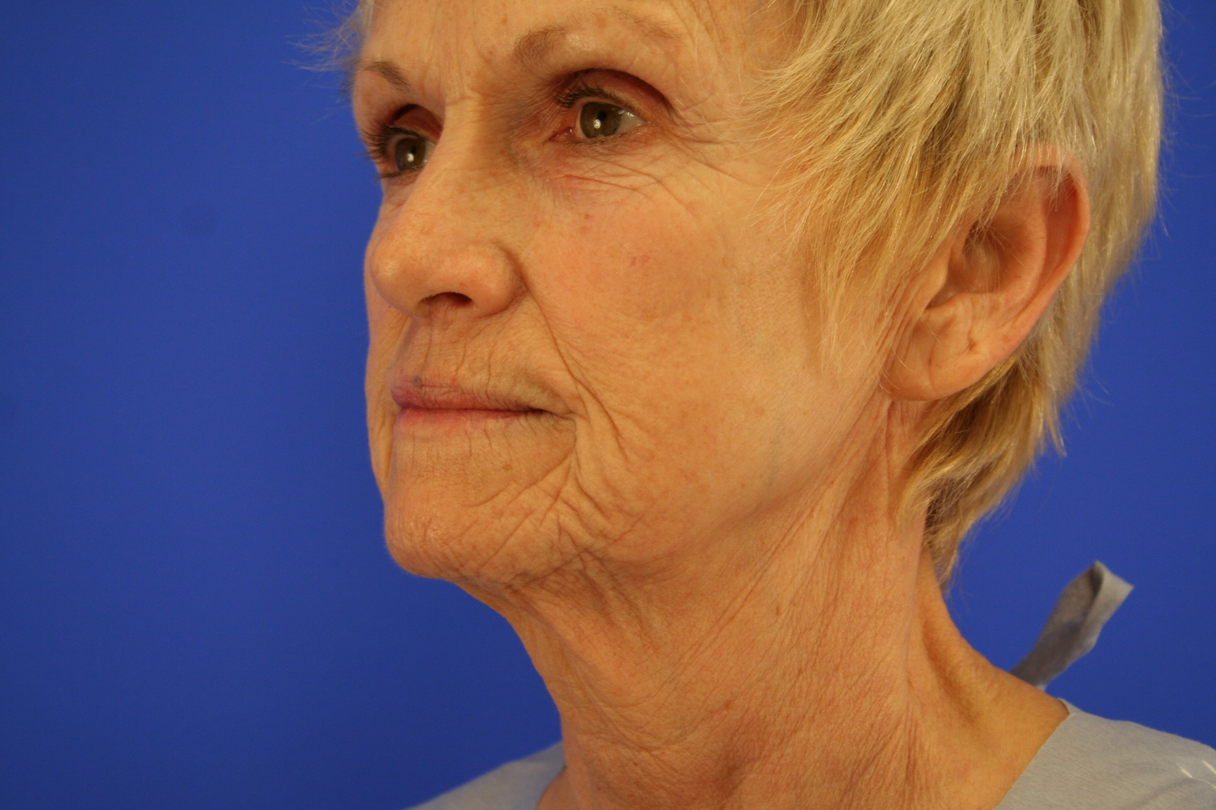 Peggy Facelft-Before Left Oblique