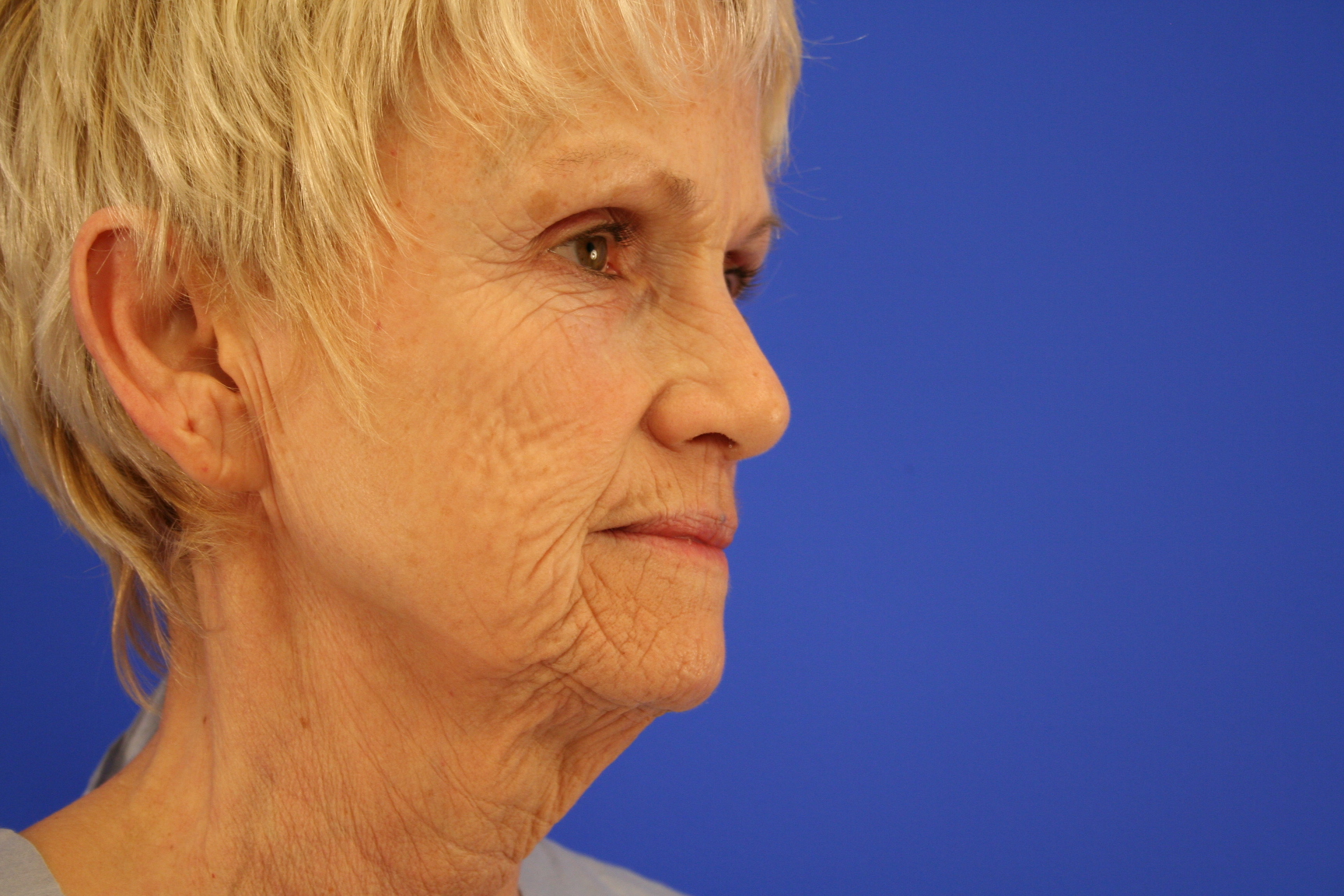Peggy Facelft-Before Right Frontal Oblique