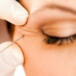 Botox for crows feet