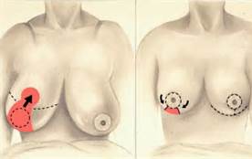 breast reduction