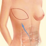 Tram flap breast reconstruction.